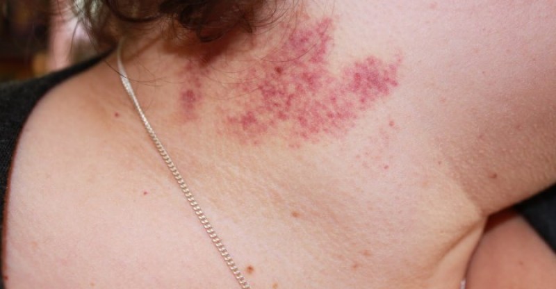 Best Remedies to Get Rid of An Embarrassing Hickeys!